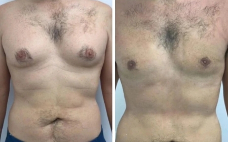 Gynecomastia in Dubai: When You Should Consider Surgery?