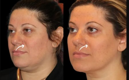 Before & After: Best Doctors in Dubai Share Stunning Sculptra Fillers Transformations