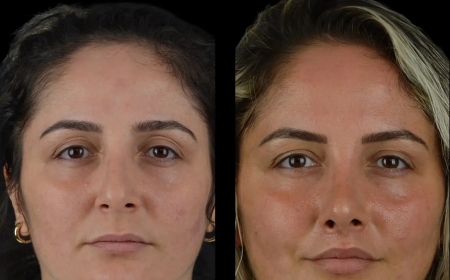 How the Best Doctors in Dubai Adjust Cheek Fillers Treatments Over Time
