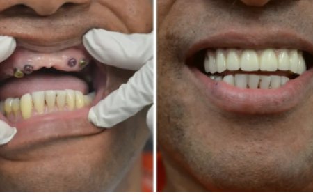 🦷 Best Dental Implants in DHA Lahore