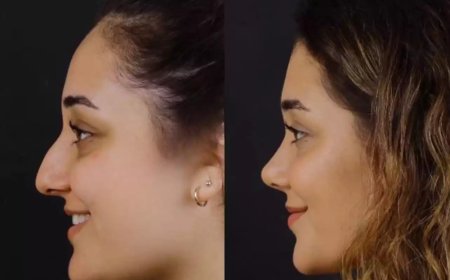 Life After Septoplasty with the Best Doctors in Dubai: What to Know