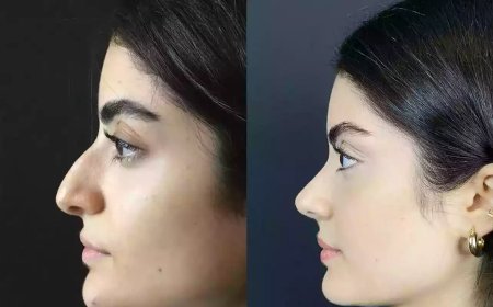 Best Doctors in Dubai Share the Latest Trends in Rhinoplasty