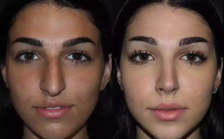Best Doctors in Dubai for Closed and Open Rhinoplasty Procedures