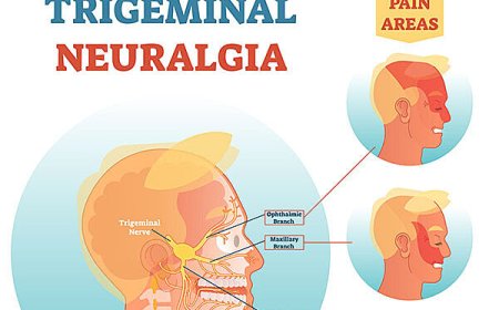 What Is Trigeminal Neuralgia? Causes, Symptoms, and Treatment Explained