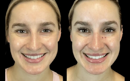 Botox in Dubai: How to Prepare for Your Treatment for Best Results