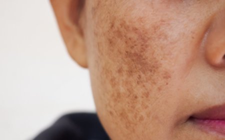 How Hormonal Changes Trigger Melasma and What to Do About It