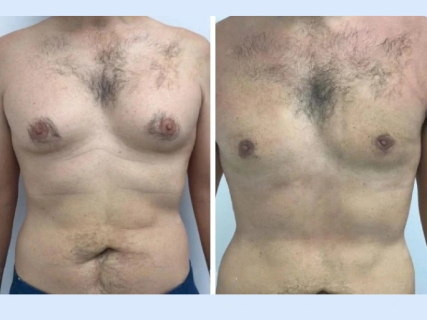 Gynecomastia in Dubai: When You Should Consider Surgery?