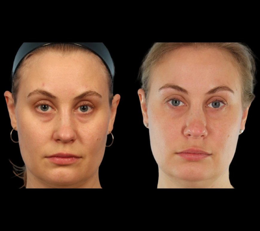 Why Under Eye Fillers from the Best Doctors in Dubai Deliver the Best Results