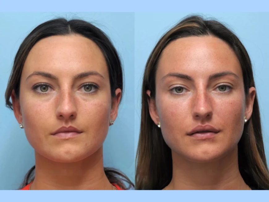 Natural Anti-Aging Results by the Best Doctors in Dubai for Thread Lift