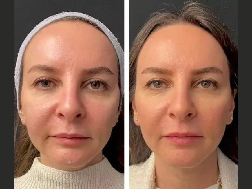 Who Is a Good Candidate for Mesotherapy? Insights from the Best Plastic Surgeon in Dubai