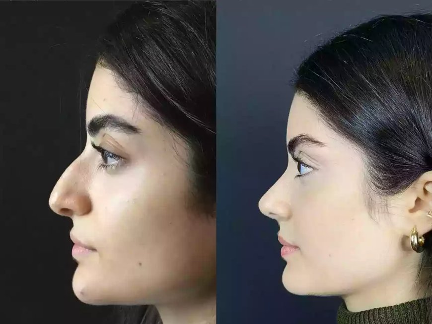 Best Doctors in Dubai Share the Latest Trends in Rhinoplasty