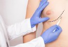 Treating One-Sided Gynecomastia: Is Surgery Different?