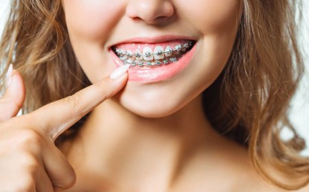 Common Myths About Braces Debunked
