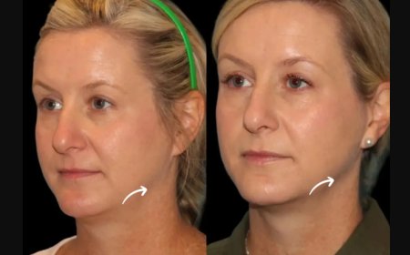 Why Sculptra Fillers in Dubai Are the Secret Weapon for Timeless Beauty