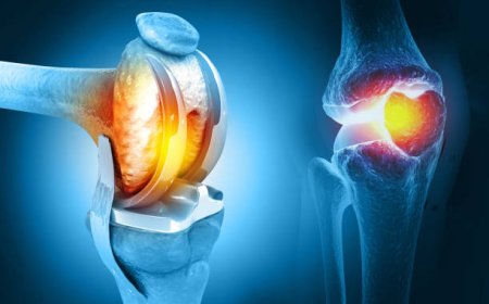 Latest Technologies in Knee Replacement: Benefits for Patients