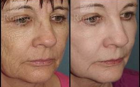 Chemical Peel Before and After for Dark Spots: Real Results You'll Love