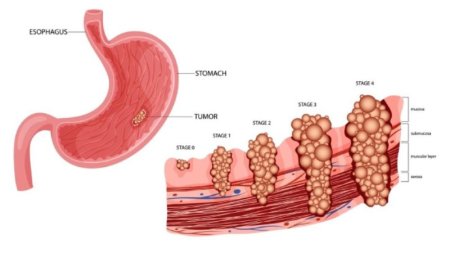 Stomach Cancer – Symptoms, Causes, and Advanced Treatment Options
