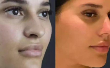 Best Rhinoplasty Surgeon in Dubai with Impressive Before and After Results