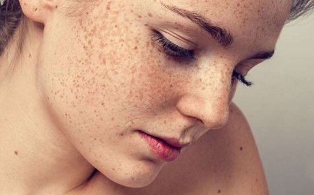 The Science Behind Melasma: What’s Happening Under Your Skin?