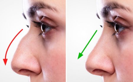 Why Patients Are Searching for the Best Rhinoplasty in Islamabad