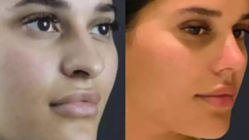 Best Rhinoplasty Surgeon in Dubai with Impressive Before and After Results