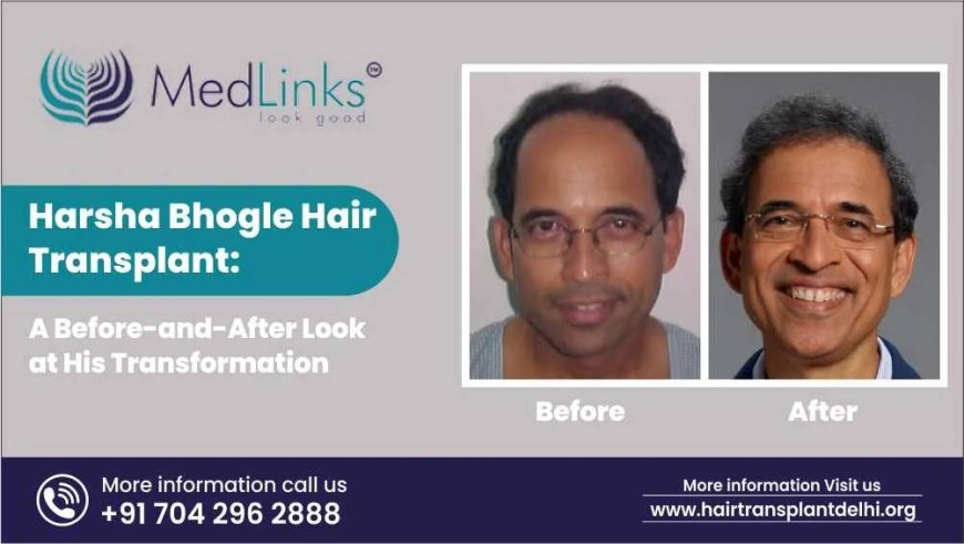 Harsha Bhogle Hair Transplant: A Before-and-After Look at His Transformation