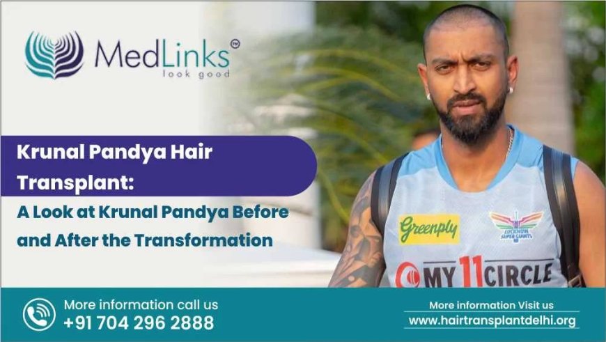 Krunal Pandya Hair Transplant: A Look at Krunal Pandya Before and After the Transformation