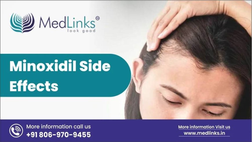 Minoxidil Side Effects: What You Need to Know Before Starting Treatment