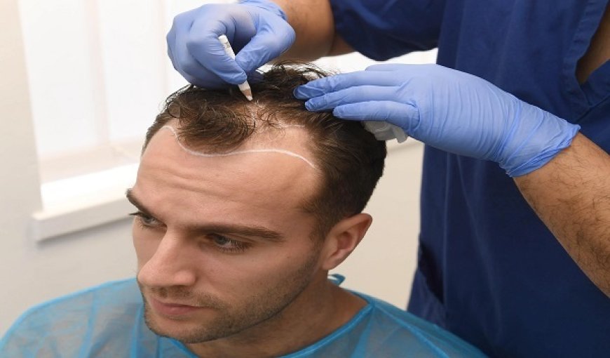Non-Shaven FUE Hair Transplant in Islamabad