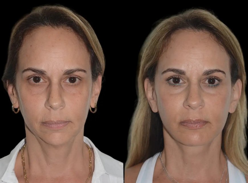 Best Plastic Surgeons in Dubai for Chin Fillers in Dubai: What to Know