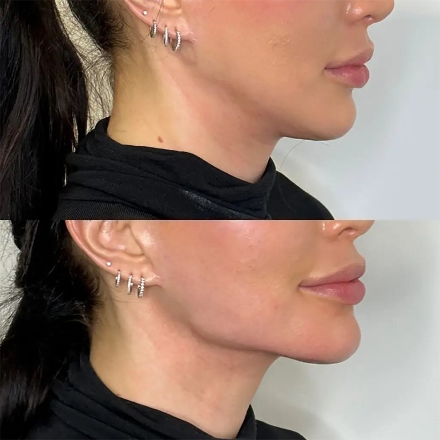 Get the Defined Jawline You’ve Always Wanted with the Best Plastic Surgeons in Dubai